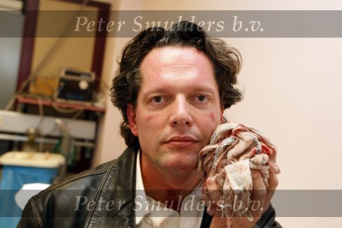 Amsterdam 12 november 2007
Guido den Aantrekker in het ziekenhuis nadat Daphne Deckers hem geslagen heeft. Guido nam net een slok van zijn champagne en het glas brak. Hij had een snee in zijn kin.