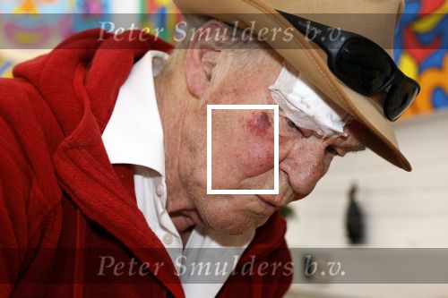 Amsterdam 1 mei 2022
Peter Faber na ongeluk in zijn atelier aan het werk.