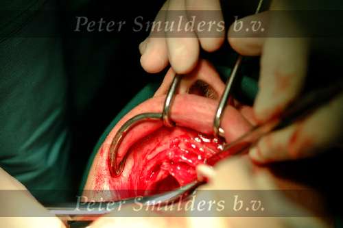 Implantaten in bovenkaak
2003
