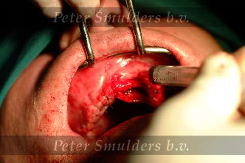 Implantaten in bovenkaak
2003