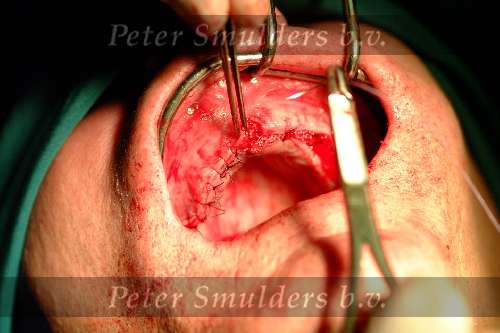 Implantaten in bovenkaken
2003
