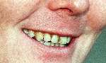 Zwolle 27 oktober 1998
Prins Willem Alexander zwaar afgeslankt en met een slecht onverzorgd gebit