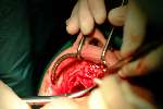 Implantaten in bovenkaak
2003