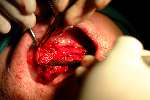Implantaten in bovenkaak
2003
Aanbrengen van kunstbot