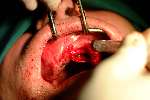 Implantaten in bovenkaak
2003
