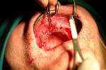 Implantaten in bovenkaken
2003
